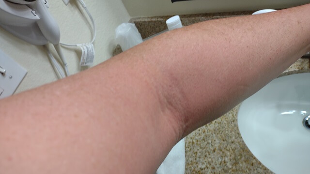 A picture of my sunburned arm that looks a surprisingly normal color even though my arm was actually very red.